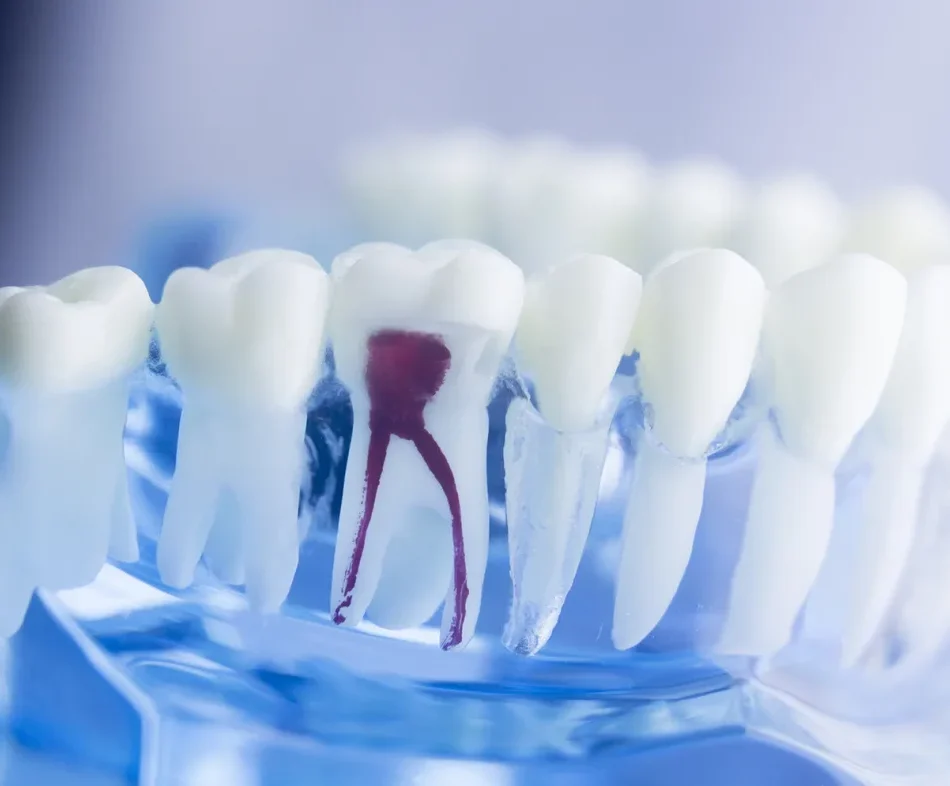 endodonti_undersida