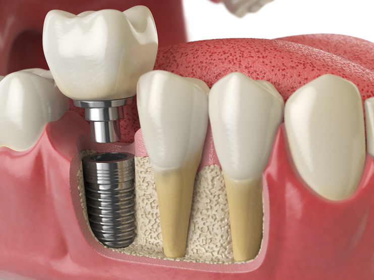 implantology implantology